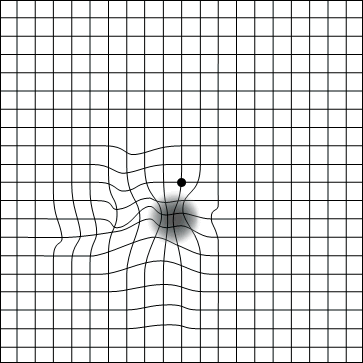 AmslerGridHole Degenerazione Maculare Legata allEtà (DMLE)
