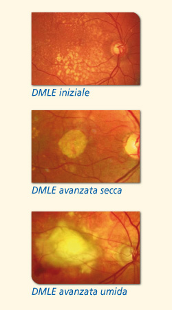 dmle Degenerazione Maculare Legata allEtà (DMLE)