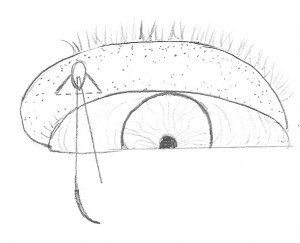 FIG. 2 Tecnica dei tre tagli (three snips) FIG. 2 Tecnica dei tre tagli (three snips). Utilizzando un paio di forbici piccole ed a punta stretta (Vannas) si eseguono 2 tagli verso il basso, per 2 mm, ad angolo acuto (30 gradi), con partenza rispettivamente 1mm a destra e 1mm a sinistra del filo.