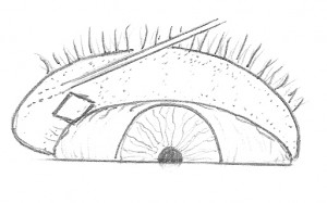 FIG. 3 Eversione palpebrale inferiore FIG. 3 Eversione palpebrale inferiore. L’eversione della palpebra inferiore viene ottenuta aiutandosi con una sonda di Bowman inserita nel canalicolo inferiore.