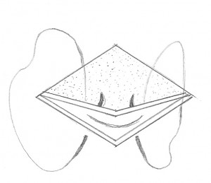 FIG. 5 Ancoraggio dei muscoli retrattori FIG. 5 Ancoraggio dei muscoli retrattori. Un filo in vycril 5-0 doppiamente armato viene fatto passare attraverso il complesso dei muscoli retrattori. Entrambi gli aghi sono poi passati attraverso il bordo superiore della incisione: medialmente attraverso la congiuntiva e lateralmente attraverso il bordo inferiore del tarso.