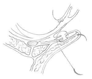 FIG. 6 Passaggio a tutto spessore attraverso la palpebra FIG. 6 Passaggio a tutto spessore attraverso la palpebra. Tutti e due gli aghi vanno poi passati dal fornice inferiore, a tutto spessore, attraverso la palpebra e fatti fuoriuscire, sulla cute, 12mm inferiormente al margine palpebrale.
