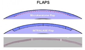 femto lasik flaps